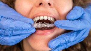 Invisalign Surrey 