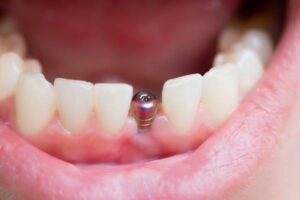  dental implants Surrey
