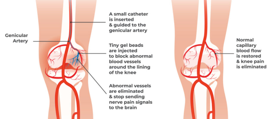 Genicular Artery Embolization