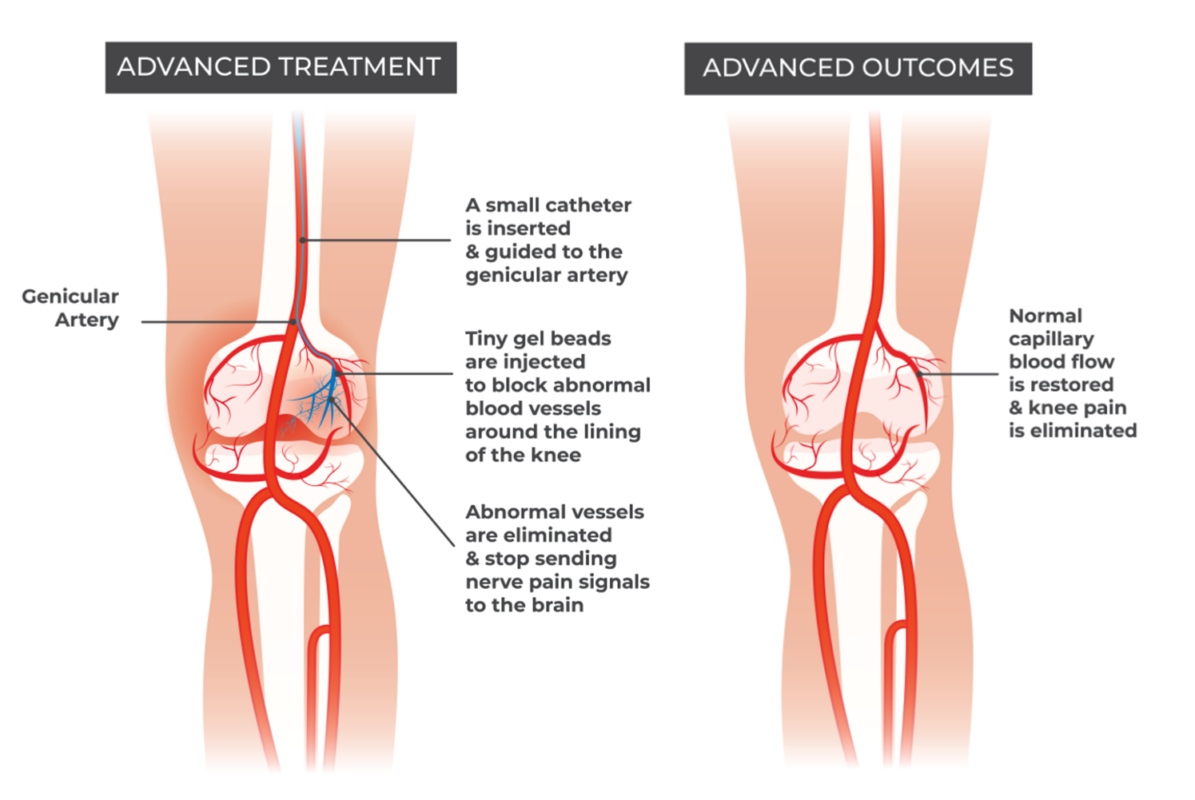 Genicular Artery Embolization: A Comprehensive Overview