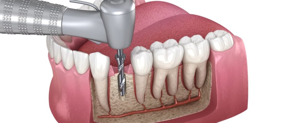 Root Canal Treatment near me