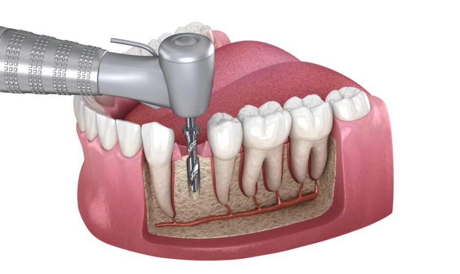 Root Canal Treatment near me