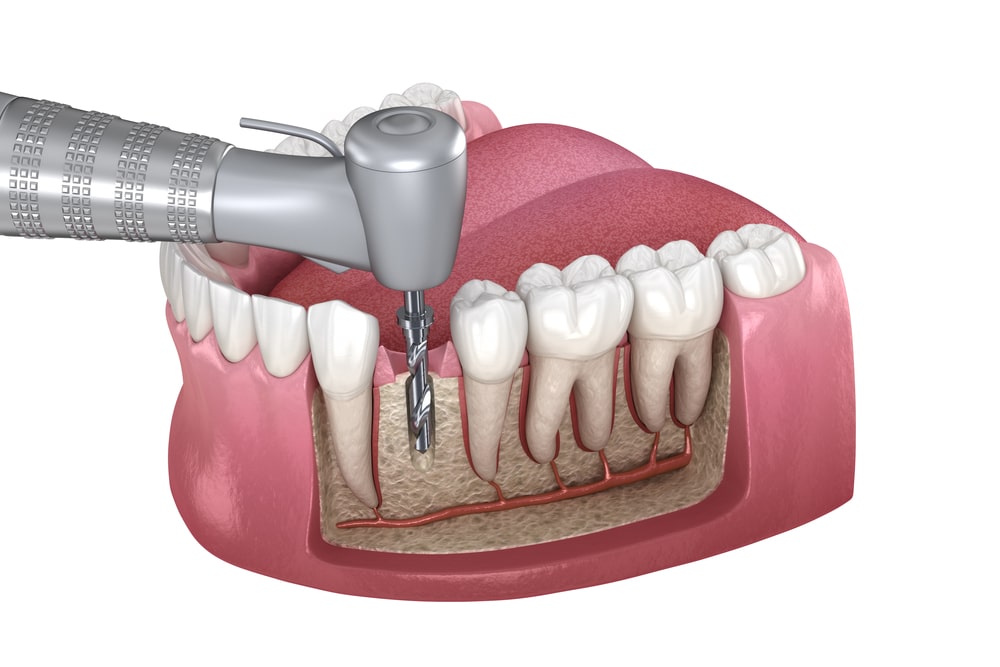 Dr. Neha Ahlawat: Trusted Dentist for RCT Treatment in Gurgaon