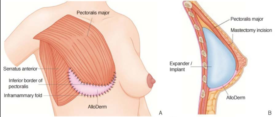 Breast Reconstruction Surgery