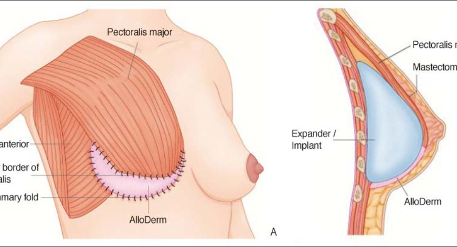 Breast Reconstruction Surgery