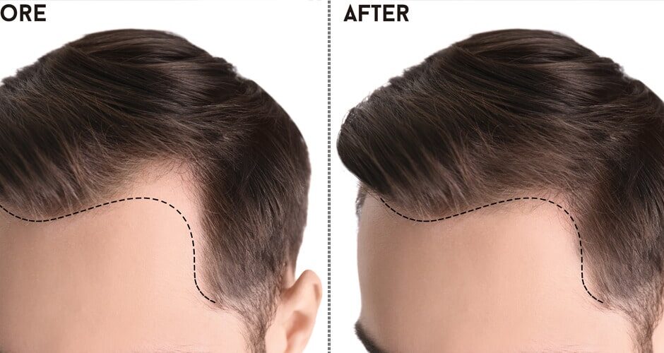 Best Hair Transplant in Islamabad