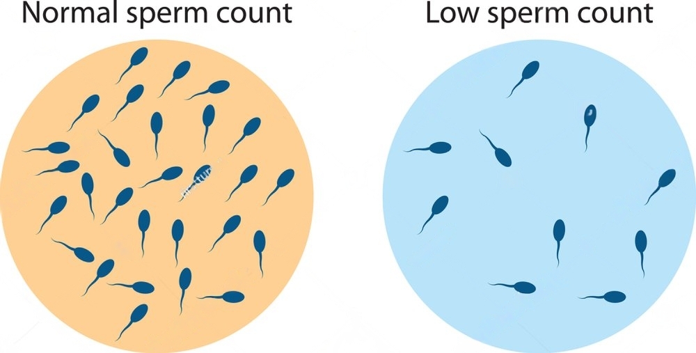 Understanding Asthenozoospermia: Effective Treatment Options in Surat