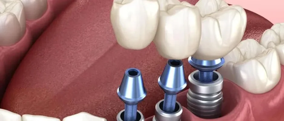 dental Implant Aberdeen