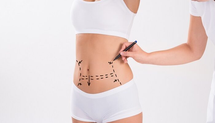 A Complete Guide to Liposuction in Islamabad