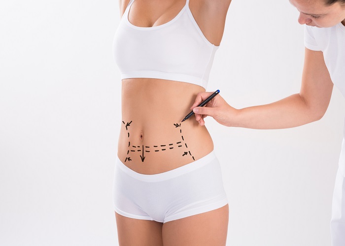 A Complete Guide to Liposuction in Islamabad