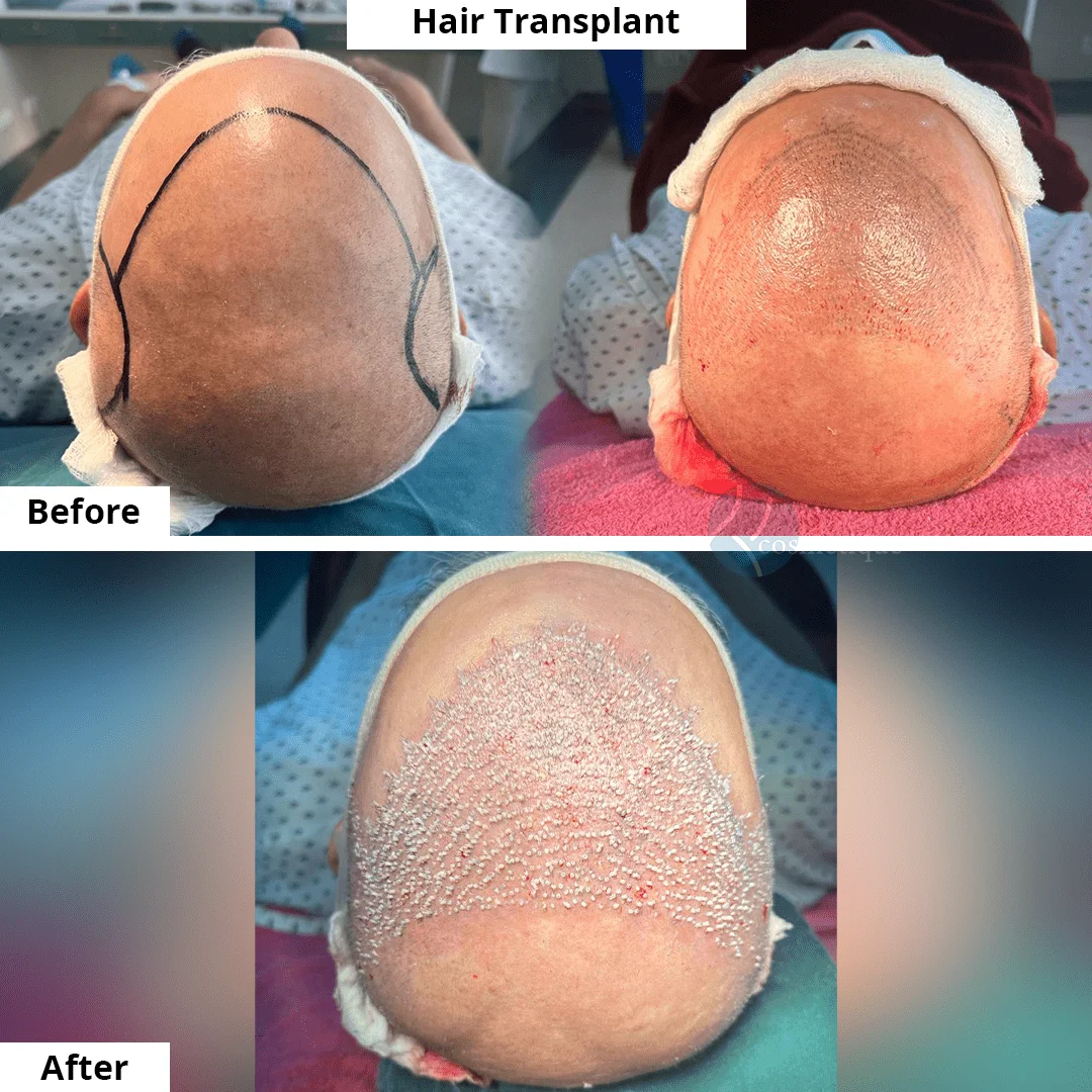 Discover Premier Hair Transplant Solutions at Institute Cosmetique, Pakistan