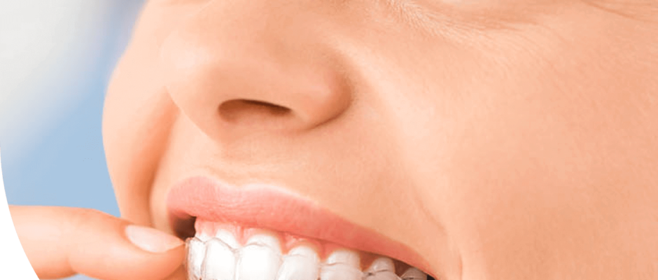 Invisalign Aberdeen