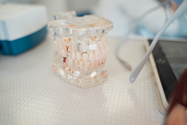 full mouth dental implants