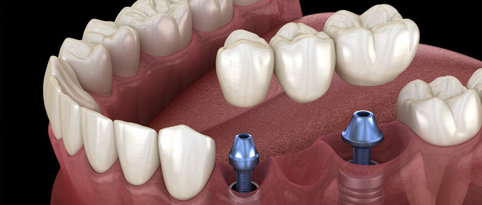 Dental Implants in Delhi