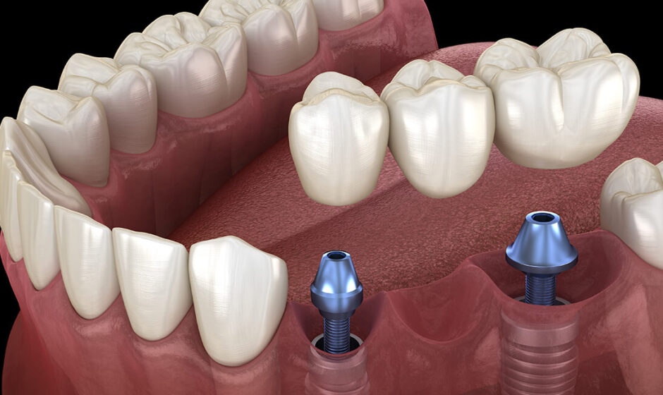 Dental Implants in Delhi