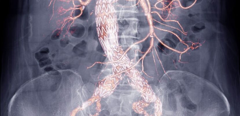 North America Aortic Stent Graft Market