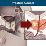 Prostate Cancer Diagnostics Market Analysis And Growth Forecast 2024-2032