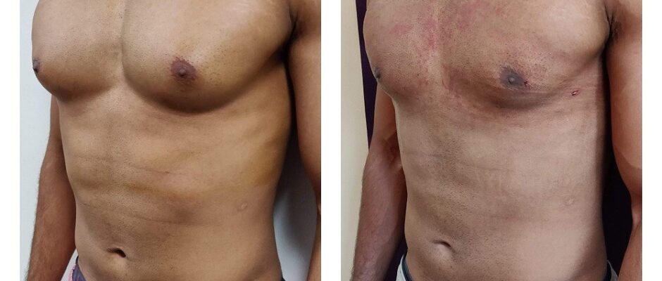 gynecomastia treatment In India