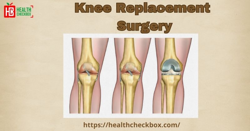 Knee Replacement Surgery