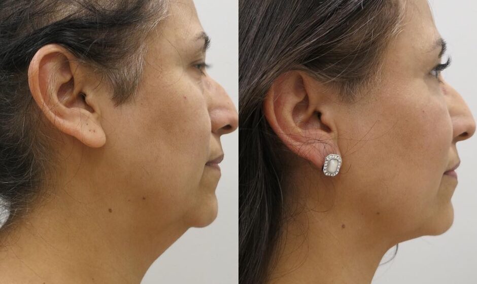 neck liposuction cost