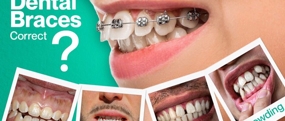 Braces in Delhi