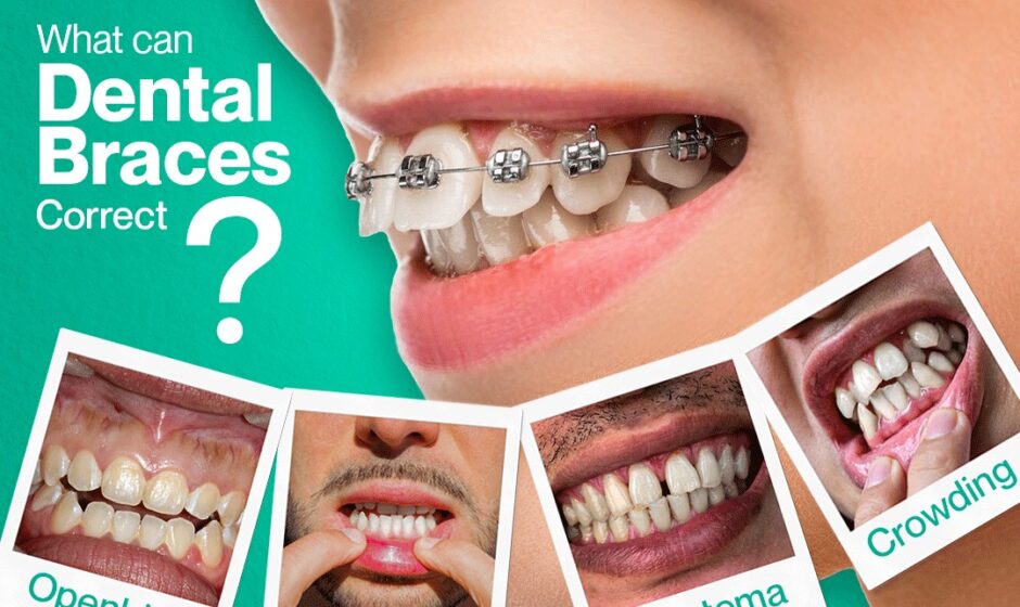 Braces in Delhi