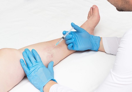 What doctor treats varicose veins