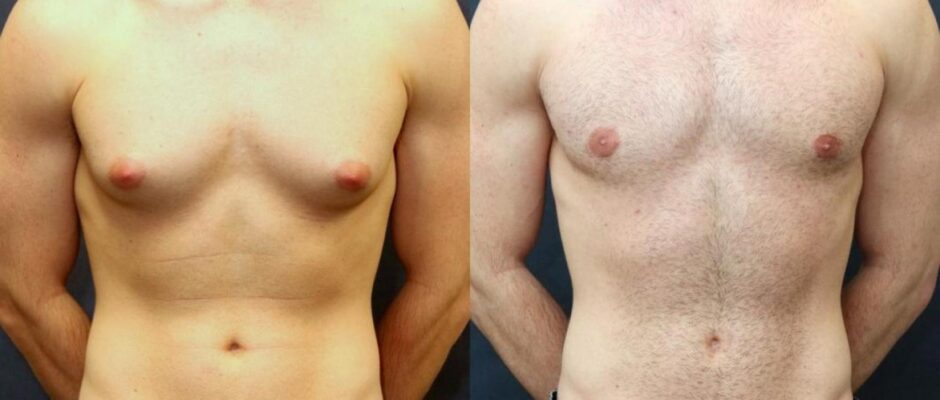 Gynecomastia Surgery