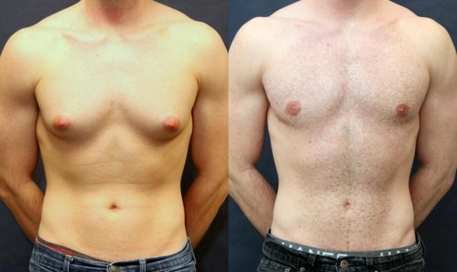 Gynecomastia Surgery