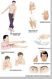 Ataxia with physiotherapy