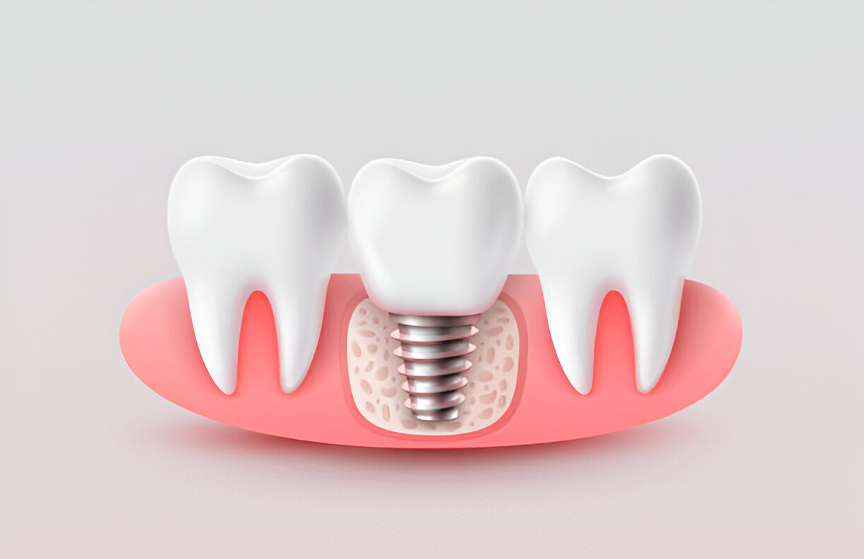 Affordable Tooth Implants in Aberdeen: Your Guide to Restoring Your Smile