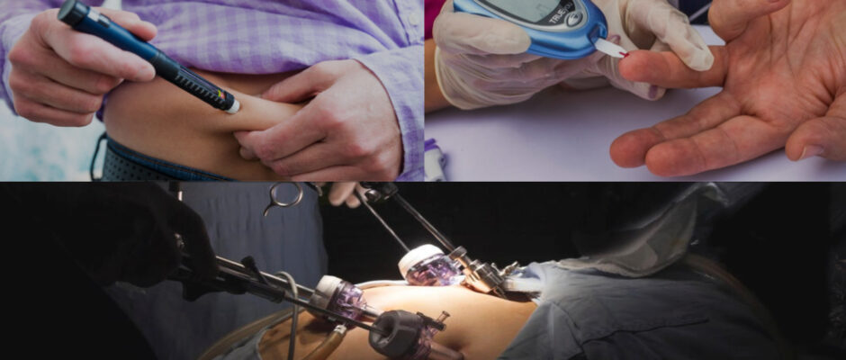 type 2 diabetes surgery