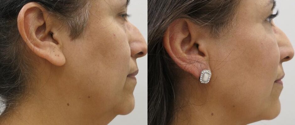 Neck Liposuction