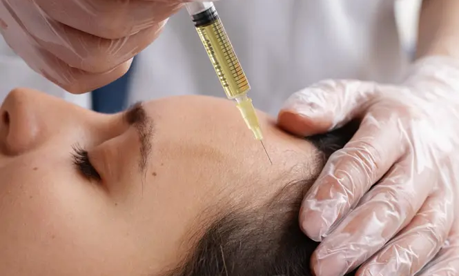PRP for Hair Restoration Fairfax