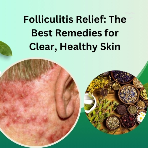 Folliculitis Relief