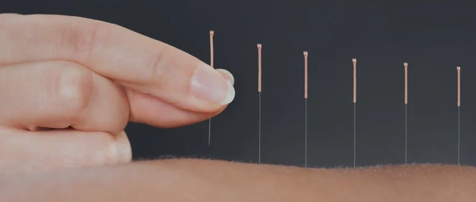 Acupuncture & Dry Needling Services in Edinburgh for Pain Relief