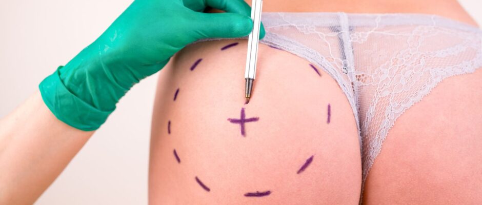 BBL vs. Implants Choosing the Right Buttock Augmentation Procedure for You