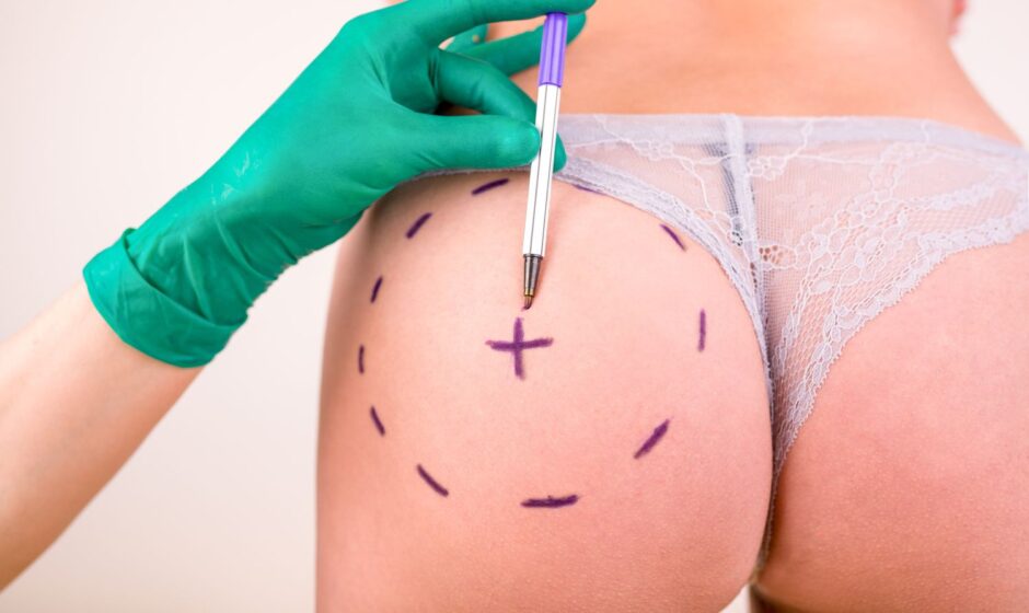BBL vs. Implants Choosing the Right Buttock Augmentation Procedure for You