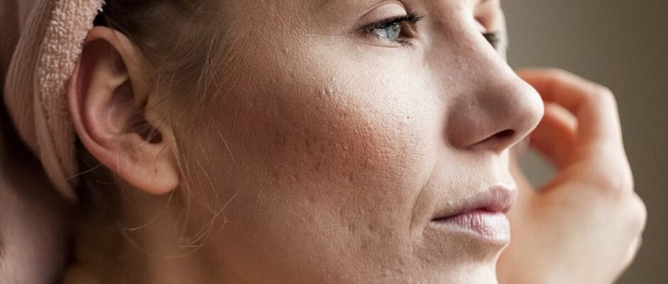 Is Acne Scar Treatment Better at a Clinic?