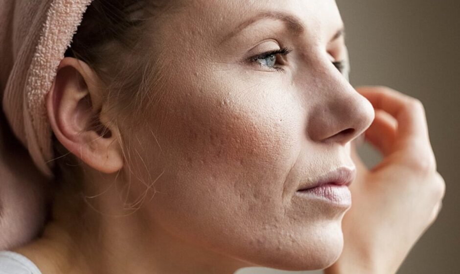 Is Acne Scar Treatment Better at a Clinic?