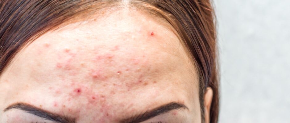 Is Acne Treatment Better Than other treatment?