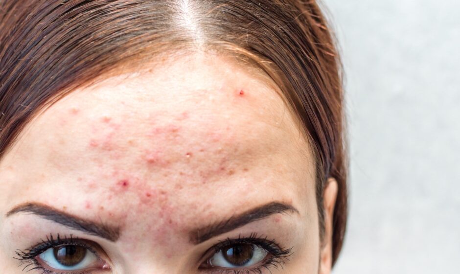 Is Acne Treatment Better Than other treatment?