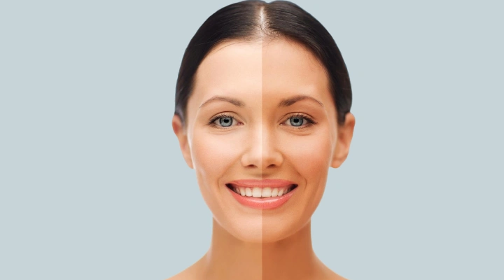 Is Skin Whitening Treatment Better Than Creams?