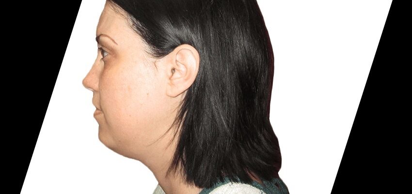 Neck Liposuction