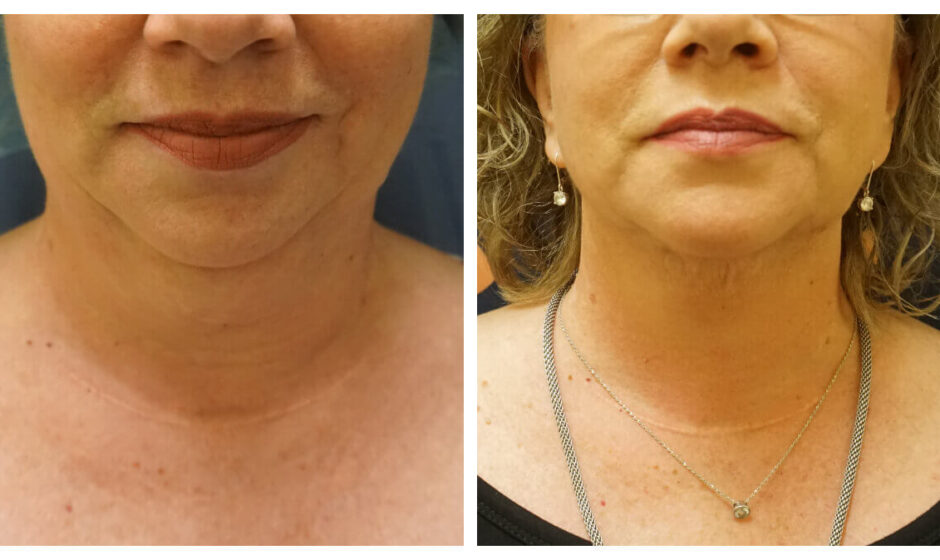 Neck Liposuction