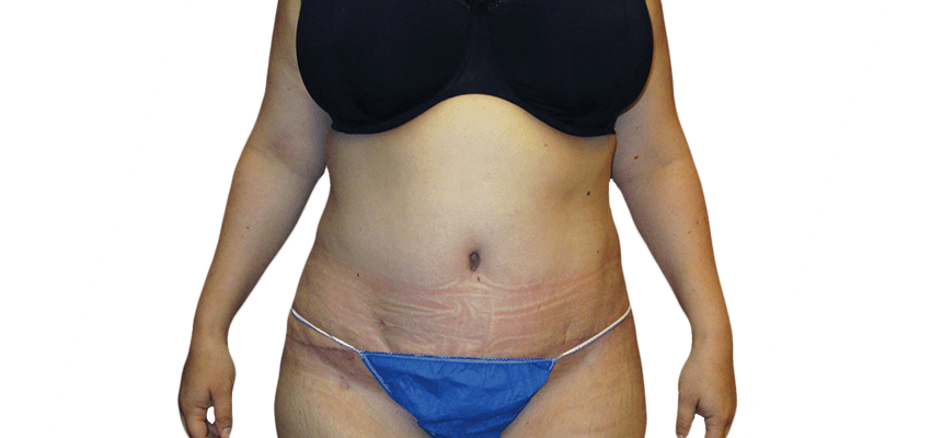 Tummy Tuck Houston