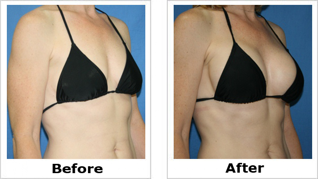 breast lift before and after