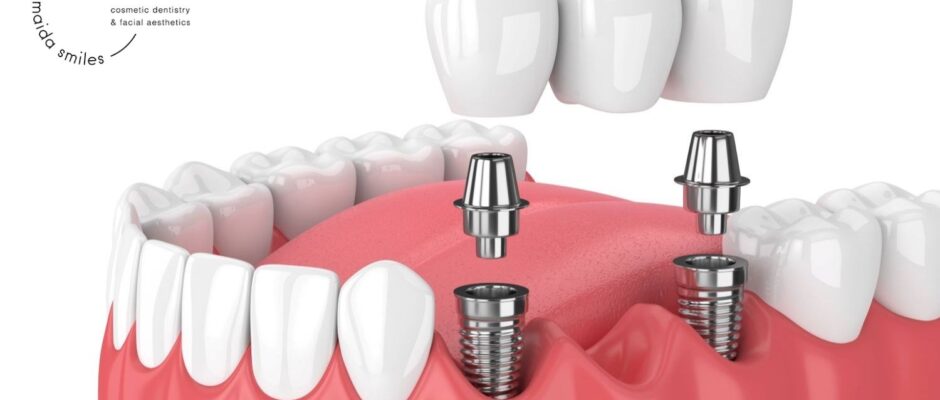 dental bridge on implants