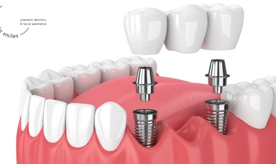 dental bridge on implants