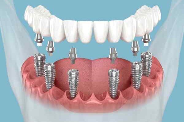 Smilo Dental Implants